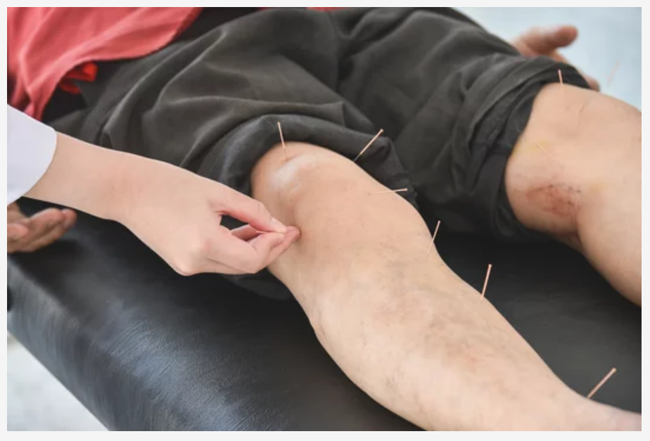 image of male person receiving acupuncture on his lower leg and knee